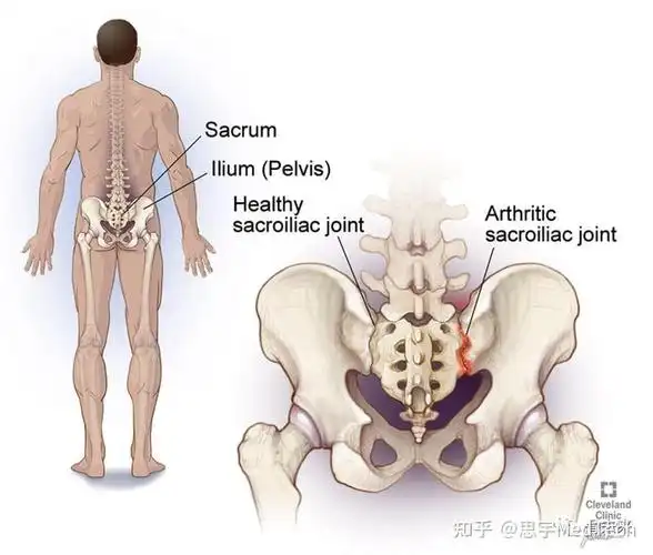 从解剖学上来说,骶髂关节位于骶骨,髂骨耳状面之间,人体左右各有一个.