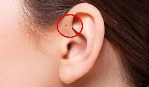 小伙伴,你们见过耳朵上有小孔的人吗?