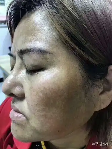 黄褐斑一定提前治疗!不然越来越严重!到… - 知乎