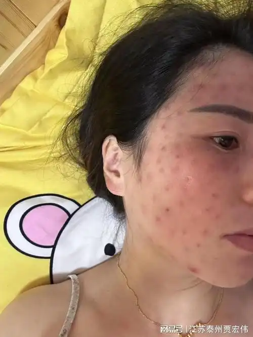 高港一女子脸上打了200针水光  两个多月脸上形成肉芽肿