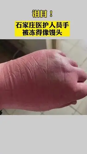 泪目!石家庄医护人员手被冻得像馒头