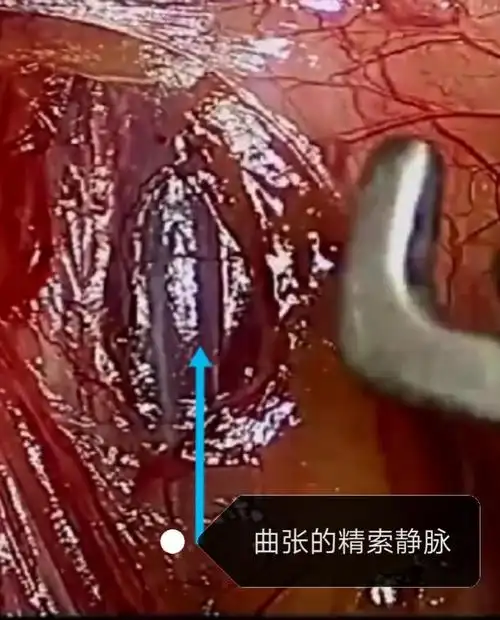 腹腔镜精索静脉曲张手术