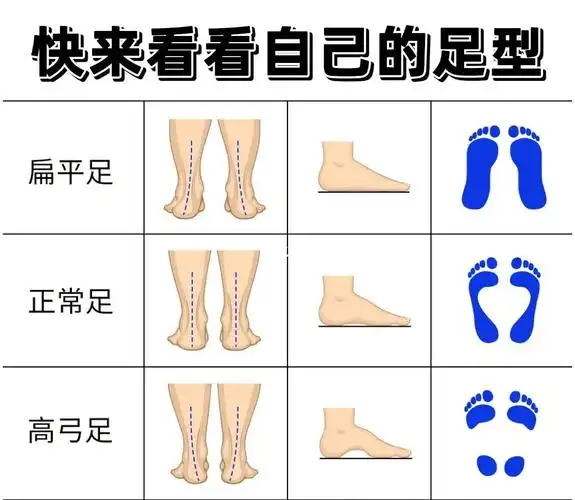 美腿必备|如何判断自己是否有扁平足?