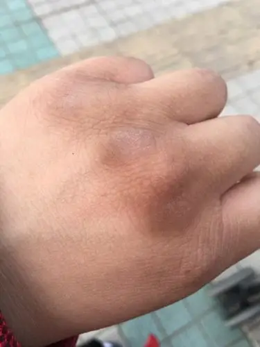 手关节的地方像长了一层黑色的茧,洗不掉,用去角质的也不行~~谁知道