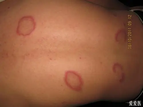 看图识病--------离心性环状红斑