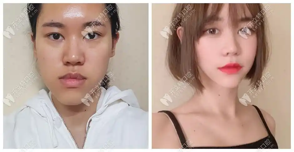 正颌手术后脸型改变图分享,有偏颌/凸嘴/地包天前后对比照 - 行业资讯