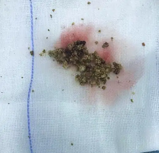 泌尿外科成功完成一例经皮肾镜左肾结石钬激光碎石取石术