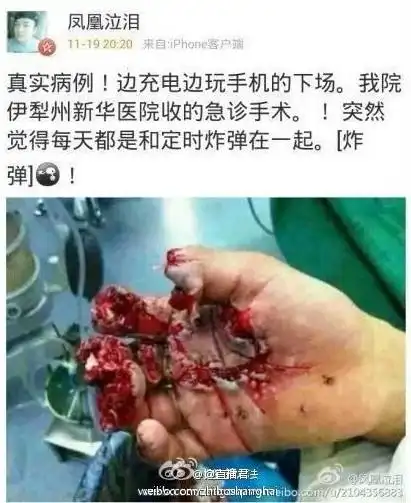 手机瞬变手雷 充电手机爆炸手掌被炸裂手指炸断