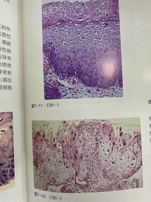 宫颈鳞状上皮内病变 - 知乎