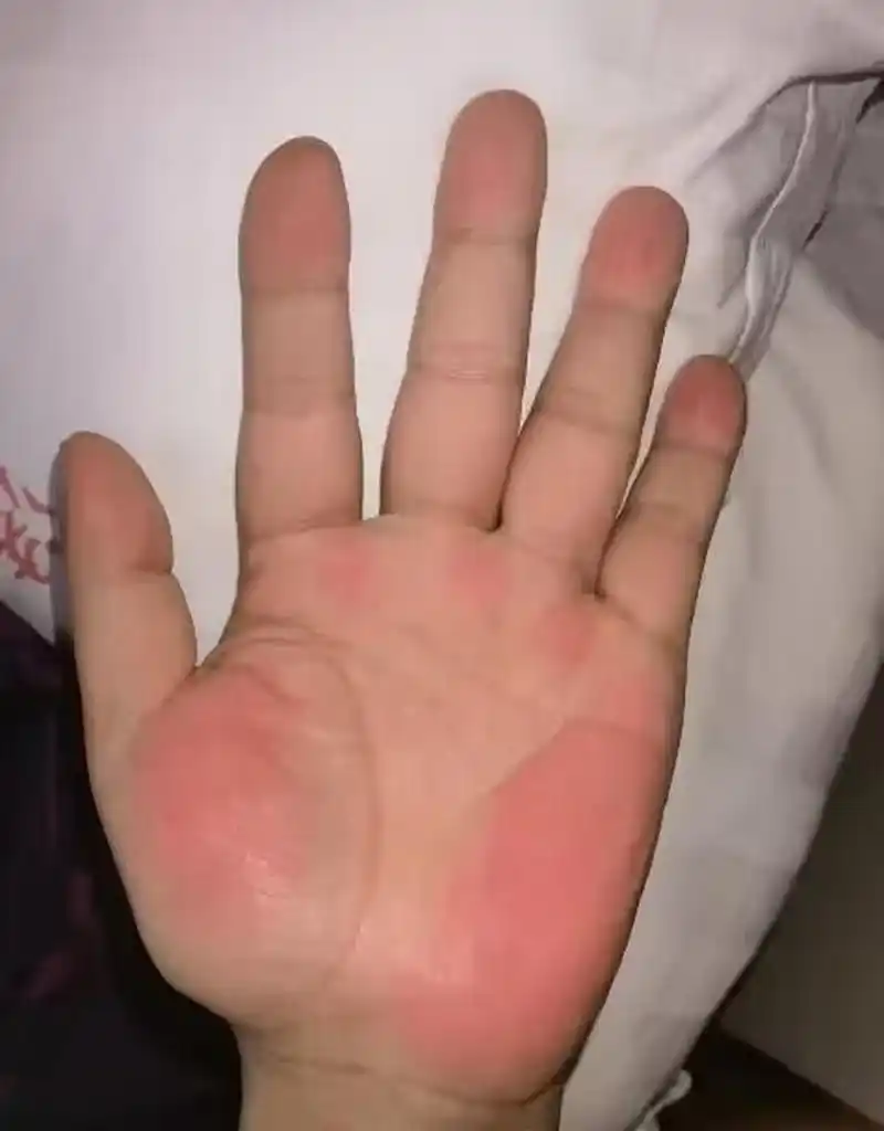 这就是肝掌,典型的肝掌!