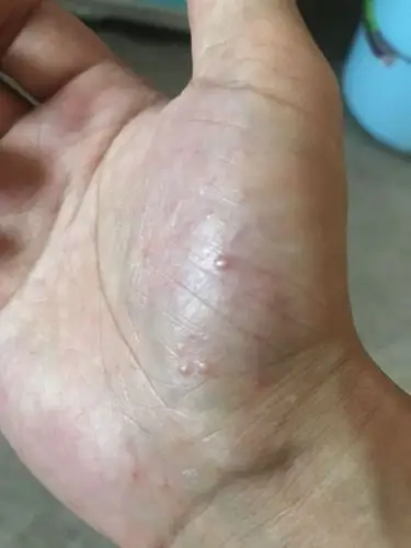 皮肤突然出现一个个小水泡,不痛不痒,是什么原因引起的?