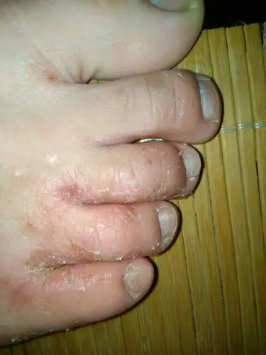 问一下这是什么病啊,脚脱皮