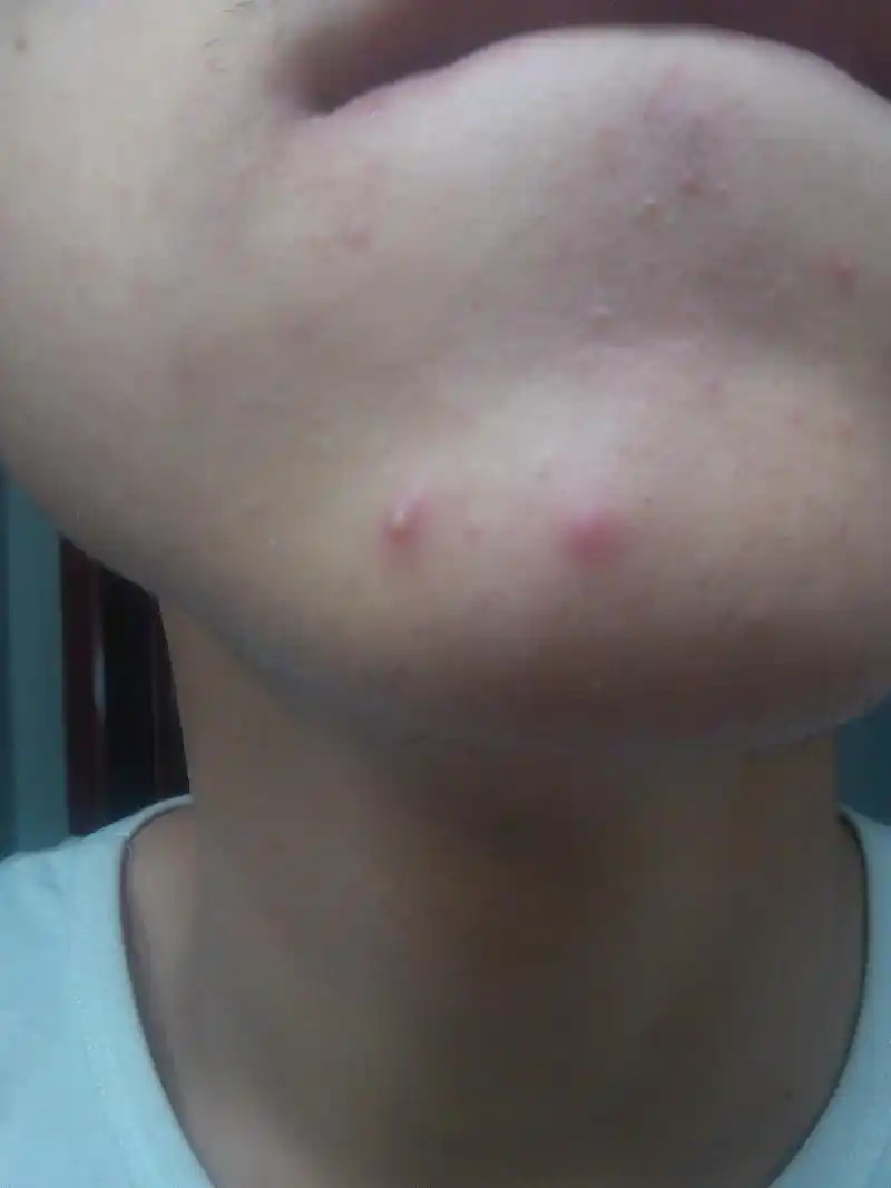 这个白色的痘痘,是青春痘吗?最近总是长