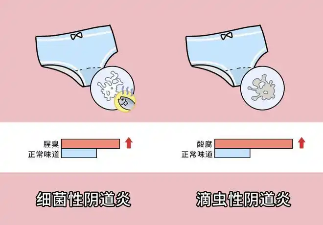 同时分泌物呈泡沫状,并伴随瘙痒症状,就需要考虑滴虫性阴道炎