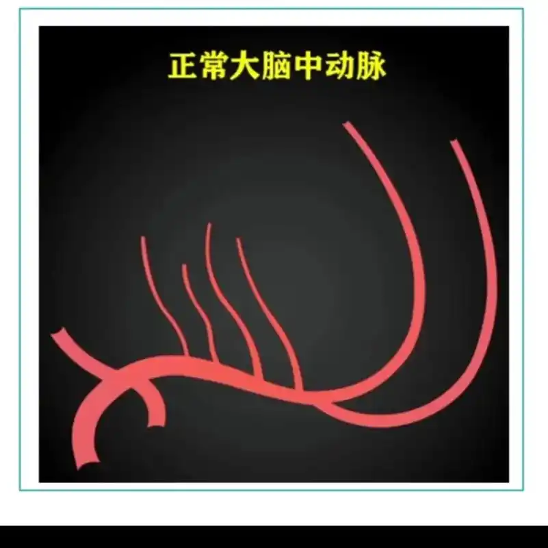 医学科普 大脑中动脉 - 抖音