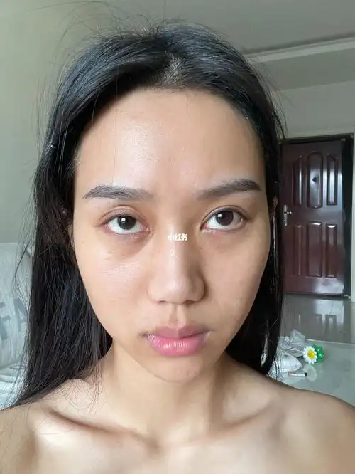 济南嗨体填充眼窝凹陷熊猫针填充泪沟