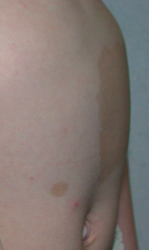 no,no,no_咖啡斑_病因_症状_发病原因_症状表现 - 好大夫在线