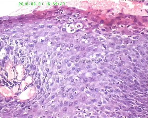 58岁女性尿道口息肉