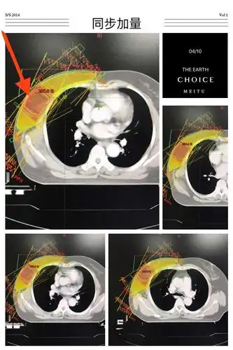 【新技术】保乳术后同步加量调强放疗