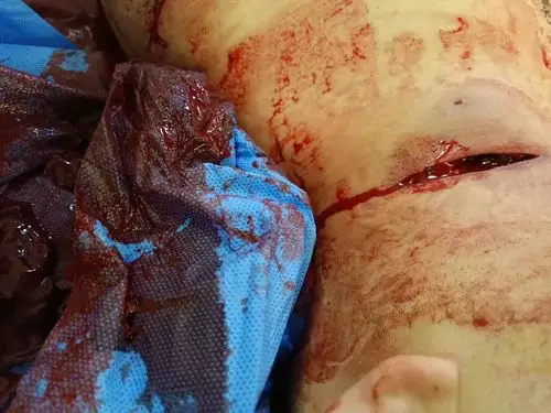 "生命至上,爱浓于血"―山西省人民医院介入科2019元旦纪实