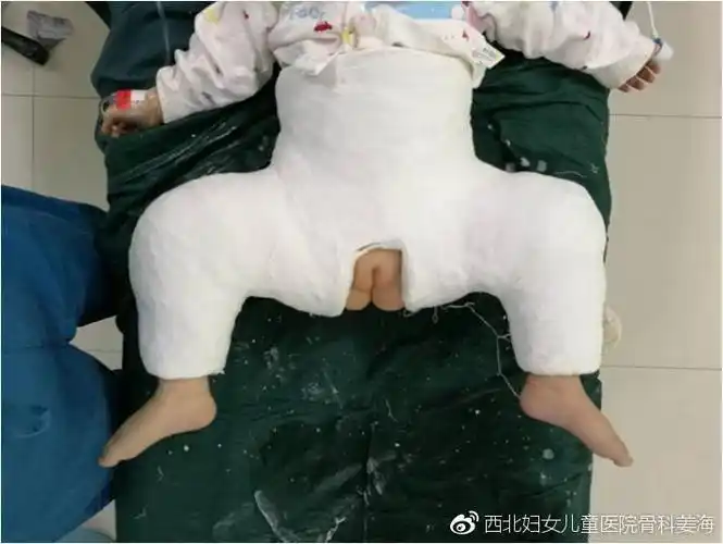 发育性髋关节发育不良