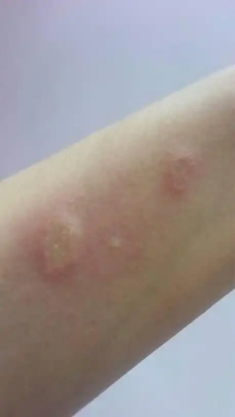昨天晚上就起了像蚊子咬得包包,很痒,早上起床就这样了,求知这是什么