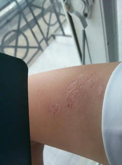 脱毛膏涂在破损的皮肤上了问题