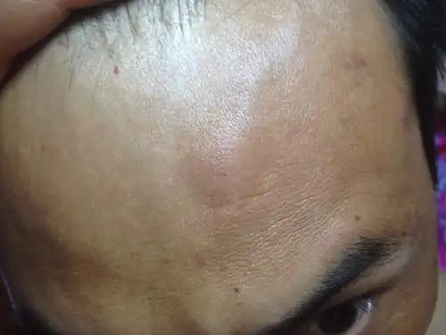 额头几年前长一小瘤摸不痛最近好像长的太快