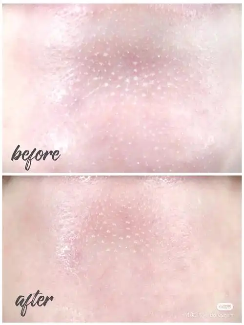 要崩溃了这种白头粉刺要怎么祛除