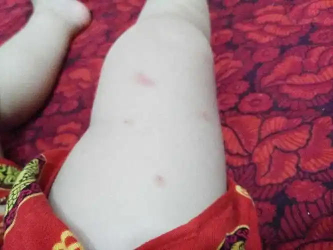 又痒.哪个宝妈能给我出出主意.非常谢谢