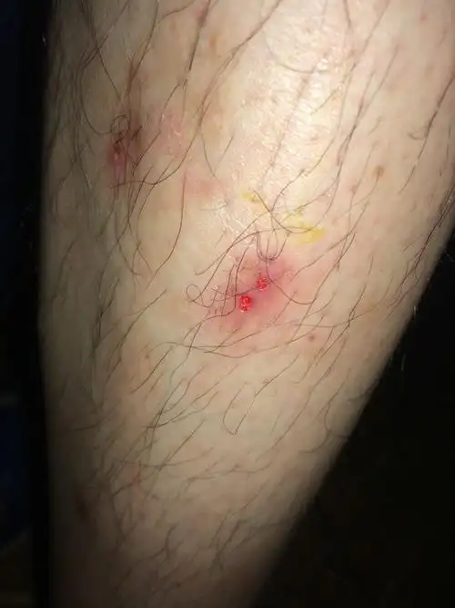 这是什么虫子咬的,被咬过的应该知道有什么症状吧.