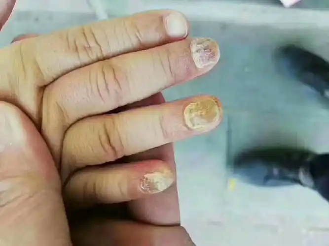 灰指甲最容易传染给宝宝