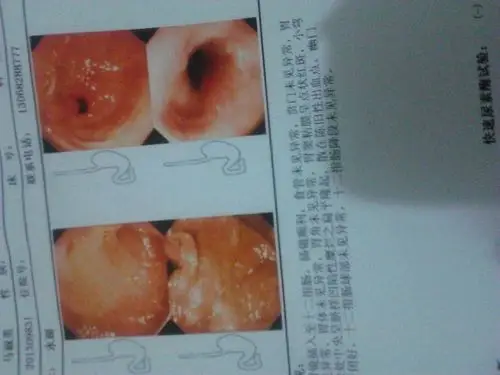 最近一个星期检查出的慢性浅表性胃炎照胃