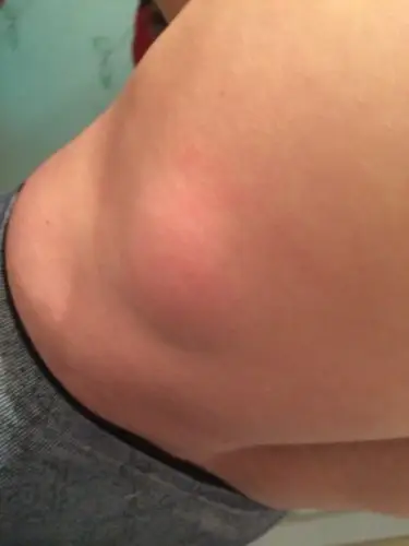 后背腰间莫名鼓出个大肉包肉肉的哪位有医学专业的高手看看