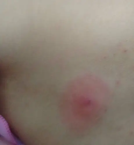 后腰上长了个硬疙瘩可以挤出脓血啦怎么回事