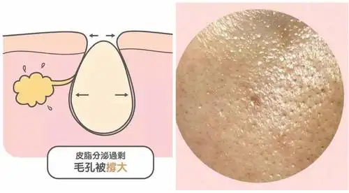 图注:皮脂腺过度分泌引起的毛孔粗大
