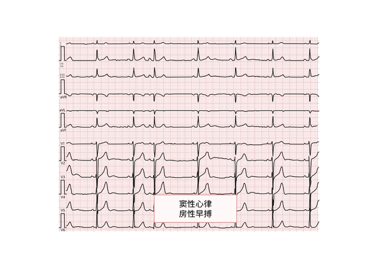 早搏的心电图波形_39健康网_精编内容