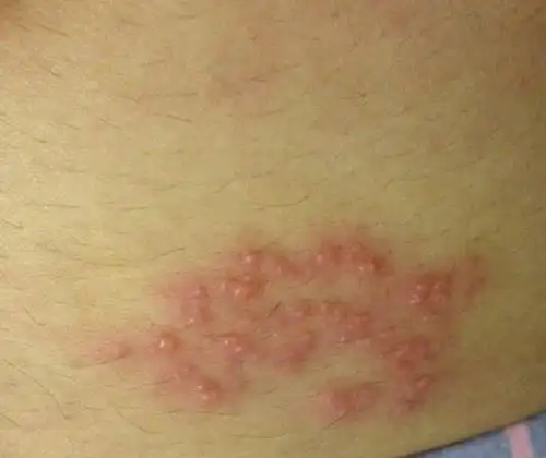 身上起了一小片红色小水泡,这是湿疹吗?怎么治疗?