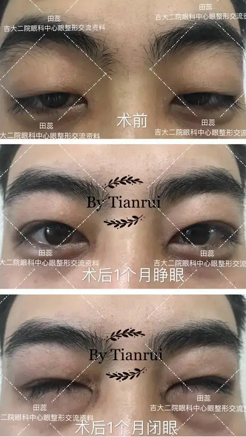 上睑下垂患者的术前术后对比图片 - 好大夫在线