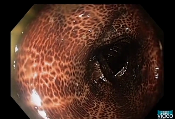 黑肠  图片来源.png