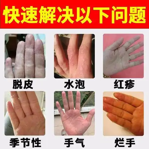 汗状疱疹手上起小水泡专用软膏真菌感染脱皮手上湿疹止痒去根喷雾