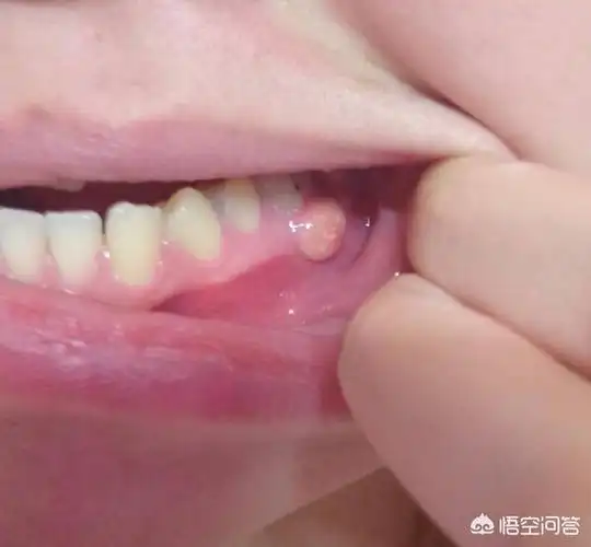 小孩牙龈上长了个包里面好像有脓该怎么办