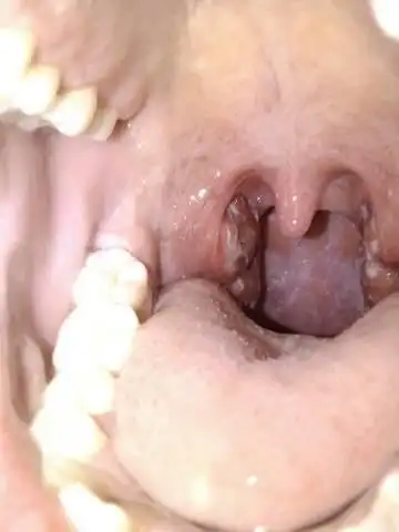 咽喉处有大量白斑,不疼但是很咽,特别是