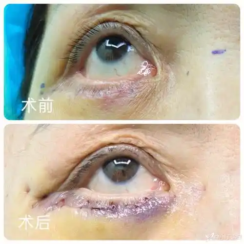 埋线悬吊固定矫正外切眼袋术后下睑轻度外翻,经验分享
