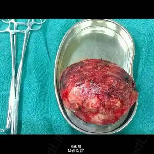 异位:右后上纵隔巨大胸腺瘤一例