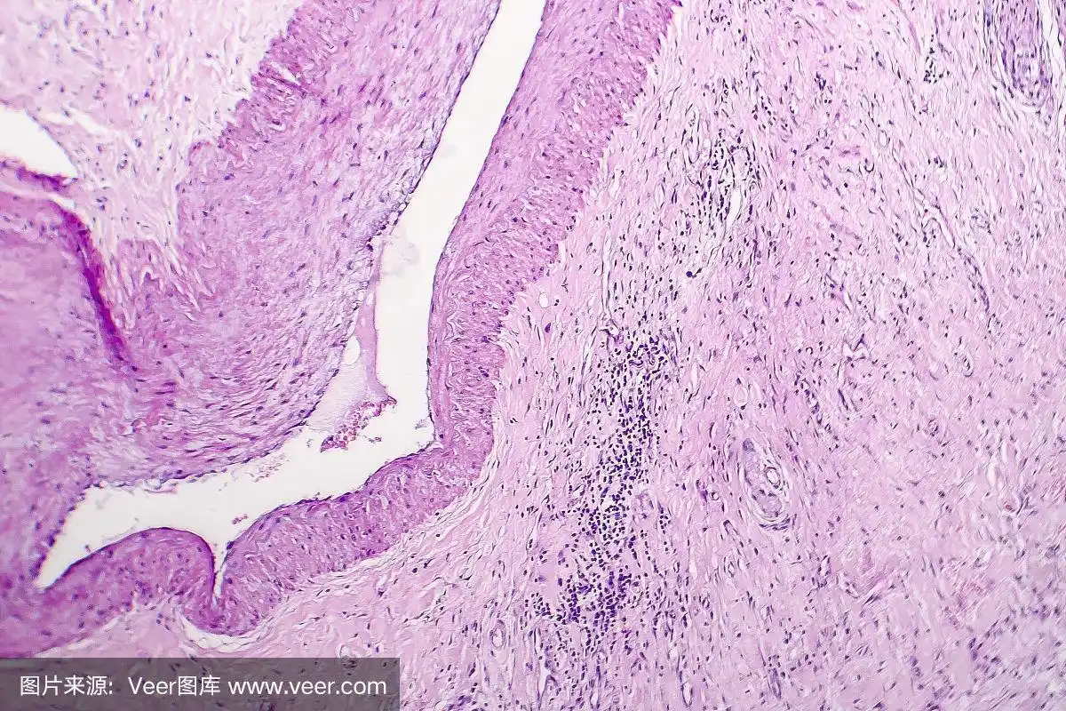 慢性胆囊炎的组织病理学