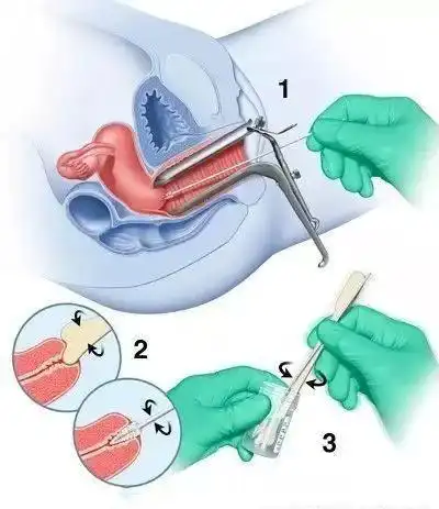 关于妇科检查你需要知道的