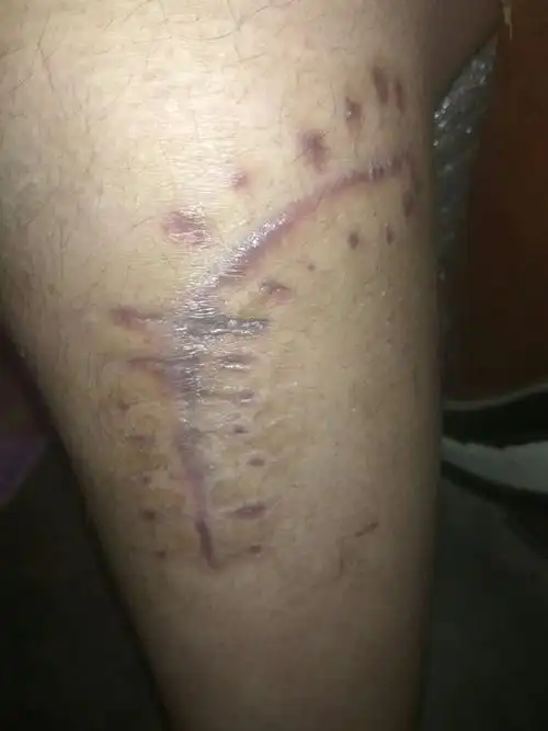 伟大的百度知道,请问手术疤这样可以遇水了吗?