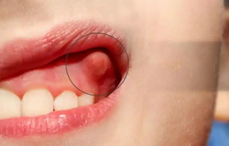 如果是牙周病引起的脓包,治疗原则是止痛防止感染扩散,先自牙周袋内或