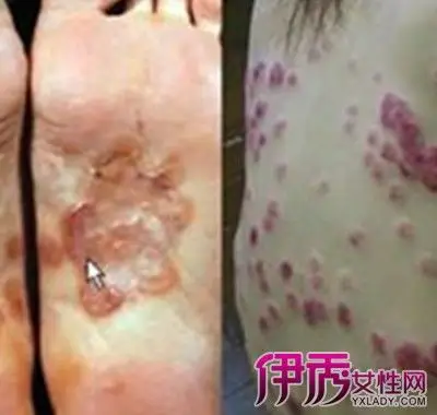 【图】女性硬下疳初期图片大曝光 小编告诉你常见症状